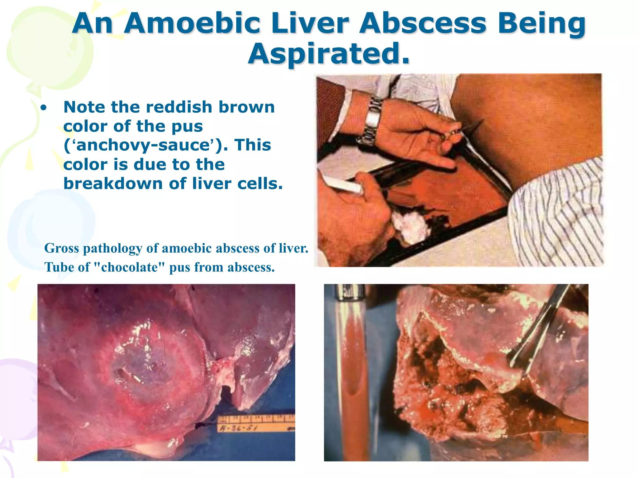 An Amoebic Liver Abscess Being
Aspirated.
• Note the reddish brown
color of the pus
(‘anchovy-sauce’). This
color is due to the
breakdown of liver cells.
Gross pathology of amoebic abscess of liver.
Tube of "chocolate" pus from abscess.
 