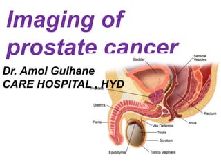 Imaging of
prostate cancer
Dr. Amol Gulhane
CARE HOSPITAL , HYD
 