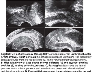 Amol april prostate cancer imaging | PPTX