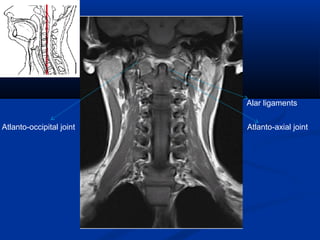 Alar ligaments
Atlanto-axial jointAtlanto-occipital joint
 
