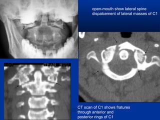 open-mouth show lateral spine
dispalcement of lateral masses of C1
CT scan of C1 shows fratures
through anterior and
posterior rings of C1
 