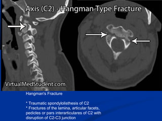 Hangman's Fracture
* Traumatic spondylolisthesis of C2
* Fractures of the lamina, articular facets,
pedicles or pars interarticulares of C2 with
disruption of C2-C3 junction
 