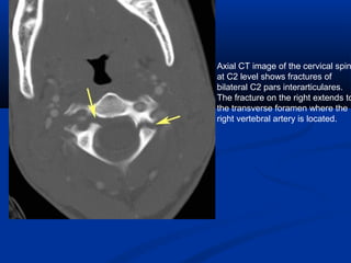 Axial CT image of the cervical spin
at C2 level shows fractures of
bilateral C2 pars interarticulares.
The fracture on the right extends to
the transverse foramen where the
right vertebral artery is located.
 