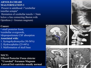 ARNOLD-CHIARI
MALFORMATION I
Present in adulthood ="cerebellar
tonsillar ectopia"
Herniation of cerebellar tonsils > 5mm
below a line connecting Basion with
Opisthion (= foramen magnum)
Causes:
• small posterior fossa,
•cerebellar overgrowth,
•disproportionate CSF absorption
Associated with:
1. Syringohydromyelia (30-56%)
2. Hydrocephalus (25-44%)
3. Malformation of skull base
NECT:
Effaced Posterior Fossa cisterns
"Crowded" Foramen Magnum
Lateral/3rd ventricles usually normal
 