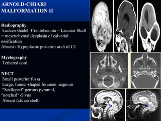 ARNOLD-CHIARI
MALFORMATION II
Radiography
Lucken shadel -Craniolacunia = Lacunar Skull
= mesenchymal dysplasia of calvarial
ossification
Absent / Hypoplastic posterior arch of C1
Myelography
Tethered cord
NECT
Small posterior fossa
Large, funnel-shaped foramen magnum
"Scalloped" petrous pyramid,
"notched" clivus
Absent falx cerebelli
 