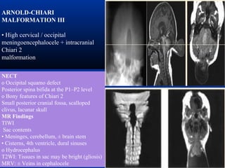 ARNOLD-CHIARI
MALFORMATION III
• High cervical / occipital
meningoencephalocele + intracranial
Chiari 2
malformation
NECT
o Occipital squamo defect
Posterior spina bifida at the P1–P2 level
o Bony features of Chiari 2
Small posterior cranial fossa, scalloped
clivus, lacunar skull
MR Findings
TIWI
Sac contents
• Meninges, cerebellum, ± brain stem
• Cisterns, 4th ventricle, dural sinuses
o Hydrocephalus
T2WI: Tissues in sac may be bright (gliosis)
MRV: ± Veins in cephalocele
 