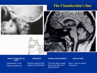 The Chamberlain’s lineThe Chamberlain’s line
NAME & SYNONYMS OF
LINES
DEFINITION NORMAL MEASUREMENT IMPLICATIONS
Chamberlain ‘s line
Palato-occipital line
Posterior pole of hard
palate to the Opisthion.
Tip of the dens usually
below and upto 3 mm
above this line.
Dens > 6mm in basilar
impression.
H O
 