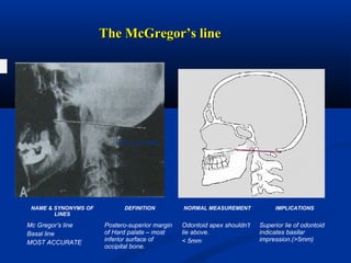 The McGregor’s lineThe McGregor’s line
H
Low occiput
NAME & SYNONYMS OF
LINES
DEFINITION NORMAL MEASUREMENT IMPLICATIONS
Mc Gregor’s line
Basal line
MOST ACCURATE
Postero-superior margin
of Hard palate – most
inferior surface of
occipital bone.
Odontoid apex shouldn’t
lie above.
< 5mm
Superior lie of odontoid
indicates basilar
impression.(>5mm)
Low occiput
 