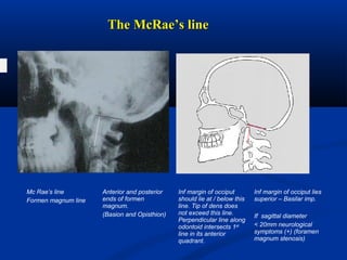 The McRae’s lineThe McRae’s line
B O
Mc Rae’s line
Formen magnum line
Anterior and posterior
ends of formen
magnum.
(Basion and Opisthion)
Inf margin of occiput
should lie at / below this
line. Tip of dens does
not exceed this line.
Perpendicular line along
odontoid intersects 1st
line in its anterior
quadrant.
Inf margin of occiput lies
superior – Basilar imp.
If sagittal diameter
< 20mm neurological
symptoms (+) (foramen
magnum stenosis)
 