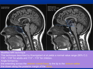 Modified MRI technique
This technique described by Koenigsbert et al yields a normal value range (95% C.I)
116° - 118° for adults and 113° - 115° for children.
Angle formed by :
line extending across the anterior cranial fossa to the tip to the dorsum sellae
line drawn along the posterior margin of the clivus
 