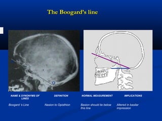 The Boogard’s lineThe Boogard’s line
N
O
NAME & SYNONYMS OF
LINES
DEFINITION NORMAL MEASUREMENT IMPLICATIONS
Boogard ‘s Line Nasion to Opisthion Basion should lie below
this line
Altered in basilar
impression
 