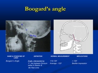 Boogard’s angleBoogard’s angle
Tuberculum sellaTuberculum sella
B o
N
Mc Ray
s
C
NAME & SYNONYMS OF
LINES
DEFINITION NORMAL MEASUREMENT IMPLICATIONS
Boogard ‘s Angle Angle intersected by
1st
line between Dorsum
sellae to Basion &
Mc Rae’s line.
119-1350
Average - 1220
> 1350
Basillar impression
 