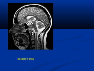 Boogard’s angle
 