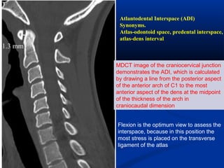 MDCT image of the craniocervical junction
demonstrates the ADI, which is calculated
by drawing a line from the posterior aspect
of the anterior arch of C1 to the most
anterior aspect of the dens at the midpoint
of the thickness of the arch in
craniocaudal dimension
Atlantodental Interspace (ADI)
Synonyms.
Atlas-odontoid space, predental interspace,
atlas-dens interval
Flexion is the optimum view to assess the
interspace, because in this position the
most stress is placed on the transverse
ligament of the atlas
 