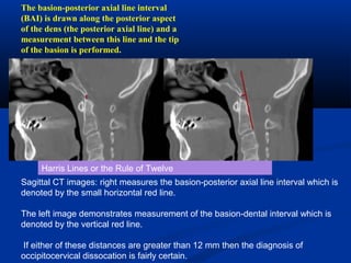 Sagittal CT images: right measures the basion-posterior axial line interval which is
denoted by the small horizontal red line.
The left image demonstrates measurement of the basion-dental interval which is
denoted by the vertical red line.
If either of these distances are greater than 12 mm then the diagnosis of
occipitocervical dissocation is fairly certain.
The basion-posterior axial line interval
(BAI) is drawn along the posterior aspect
of the dens (the posterior axial line) and a
measurement between this line and the tip
of the basion is performed.
Harris Lines or the Rule of Twelve
 