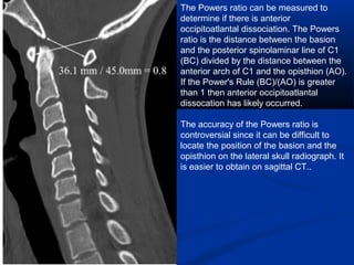 The Powers ratio can be measured to
determine if there is anterior
occipitoatlantal dissociation. The Powers
ratio is the distance between the basion
and the posterior spinolaminar line of C1
(BC) divided by the distance between the
anterior arch of C1 and the opisthion (AO).
If the Power's Rule (BC)/(AO) is greater
than 1 then anterior occipitoatlantal
dissocation has likely occurred.
The accuracy of the Powers ratio is
controversial since it can be difficult to
locate the position of the basion and the
opisthion on the lateral skull radiograph. It
is easier to obtain on sagittal CT..
 