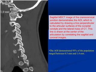 Sagittal MDCT image of the craniocervical
junction demonstrates the AOI, which is
calculated by drawing a line perpendicular
to the articular surfaces of the occipital
condyle and the lateral mass of C1. This
line is drawn at the center of the
articulation by correlating the sagittal and
coronal images.
•The AOI demonstrated 95% of the population
ranged between 0.5 mm and 1.4 mm.
 