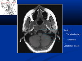 Cerebellar tonsils
medulla
Vertebral artery
basion
 