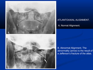 ATLANTOAXIAL ALIGNMENT.
A. Normal Alignment.
B. Abnormal Alignment. The
abnormality (arrow) is the result of
a Jefferson’s fracture of the atlas.
 