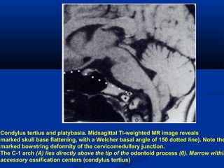 Condylus tertius and platybasia. Midsagittal Ti-weighted MR image reveals
marked skull base flattening, with a Welcher basal angle of 150 dotted line). Note the
marked bowstring deformity of the cervicomedullary junction.
The C-1 arch (A) lies directly above the tip of the odontoid process (0). Marrow within
accessory ossification centers (condylus tertius)
 