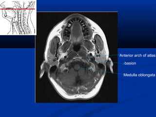 Medulla oblongata
basion
Anterior arch of atlas
 