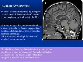•BASILAR INVAGINATION
•Floor of the skull is indented by the upper
cervical spine, & hence the tip of odontoid
is more cephalad protruding into the FM.
•Primary invagination can be associated
with occipito atlantal fusion, hypoplasia of
the atlas, a bifid posterior arch of the atlas,
odontoid anomalies.
•BI is associated with high incidence of
vertebral artery anomalies.
Chamberlain’s line- tip of dens is >6mm above this line
Mc Gregor’s line- tip of dens is > 5mm above this line
Mc Rae’s line- tip of dens is above this line
Boogard’s line- basion is above this line
 