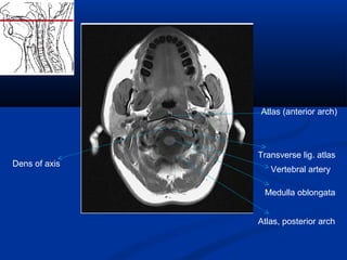 Atlas (anterior arch)
Transverse lig. atlas
Dens of axis
Medulla oblongata
Vertebral artery
Atlas, posterior arch
 