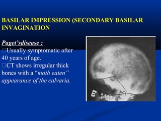 BASILAR IMPRESSION (SECONDARY BASILAR
INVAGINATION
Paget’sdisease :
�Usually symptomatic after
40 years of age.
�CT shows irregular thick
bones with a “moth eaten”
appearance of the calvaria.
 