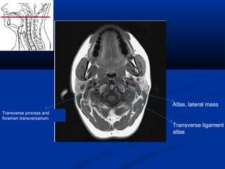 Atlas, lateral mass
Transverse ligament
atlas
Transverse process and
foramen transversarium
 