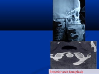 Posterior arch hemiplasia
 