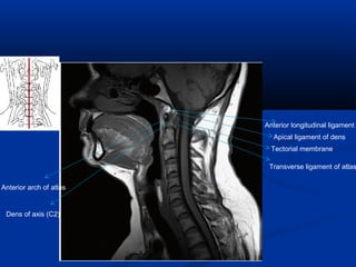 Anterior longitudinal ligament
Apical ligament of dens
Tectorial membrane
Transverse ligament of atlas
Anterior arch of atlas
Dens of axis (C2)
 