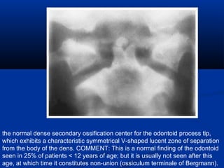 the normal dense secondary ossification center for the odontoid process tip,
which exhibits a characteristic symmetrical V-shaped lucent zone of separation
from the body of the dens. COMMENT: This is a normal finding of the odontoid
seen in 25% of patients < 12 years of age; but it is usually not seen after this
age, at which time it constitutes non-union (ossiculum terminale of Bergmann).
 