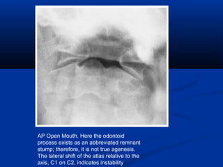 AP Open Mouth. Here the odontoid
process exists as an abbreviated remnant
stump; therefore, it is not true agenesis.
The lateral shift of the atlas relative to the
axis, C1 on C2, indicates instability
 