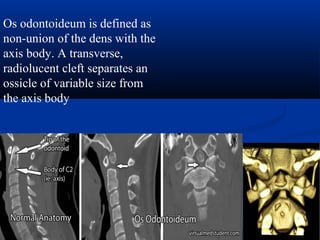 Os odontoideum is defined as
non-union of the dens with the
axis body. A transverse,
radiolucent cleft separates an
ossicle of variable size from
the axis body
 