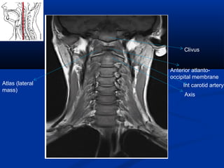 Clivus
Anterior atlanto-
occipital membrane
Atlas (lateral
mass)
Axis
Int carotid artery
 
