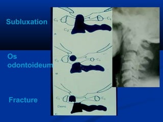Subluxation
Os
odontoideum
Fracture
 