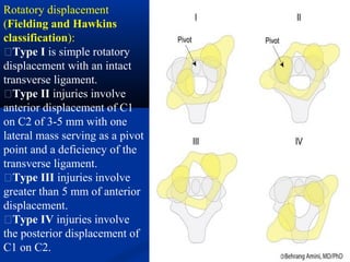 Rotatory displacement
(Fielding and Hawkins
classification):
�Type I is simple rotatory
displacement with an intact
transverse ligament.
�Type II injuries involve
anterior displacement of C1
on C2 of 3-5 mm with one
lateral mass serving as a pivot
point and a deficiency of the
transverse ligament.
�Type III injuries involve
greater than 5 mm of anterior
displacement.
�Type IV injuries involve
the posterior displacement of
C1 on C2.
 
