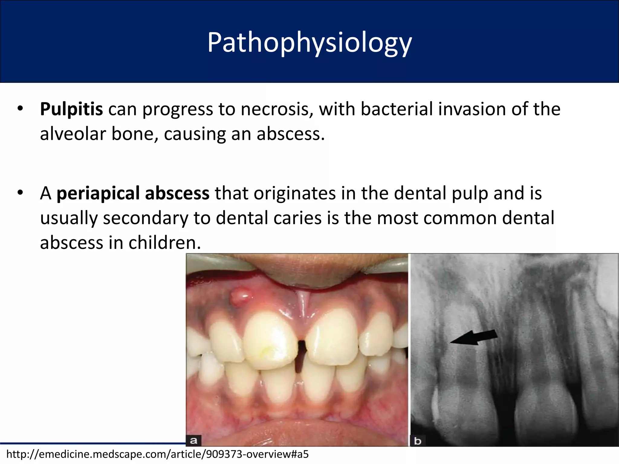 Amoxicillin in dentistry | PPTX