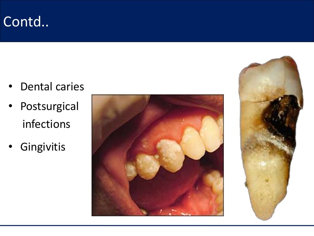 Amoxicillin in dentistry