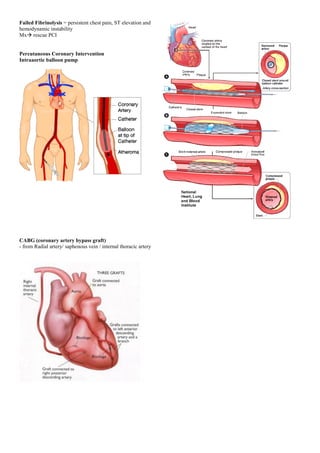 Failed Fibrinolysis = persistent chest pain, ST elevation and
hemodynamic instability
Mx rescue PCI
Percutaneous Coronary Intervention
Intraaortic balloon pump
CABG (coronary artery bypass graft)
- from Radial artery/ saphenous vein / internal thoracic artery
 