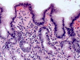 Follicules lymphoïdes