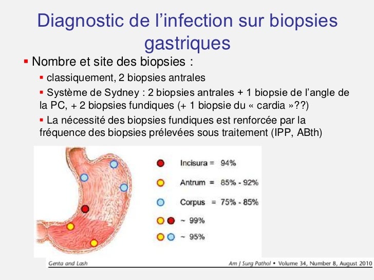 Biopsies Antrales Et Fundiques A La Recherche D Hp