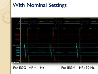 With Nominal Settings
For ECG –HP = 1 Hz For IEGM – HP : 30 Hz
 