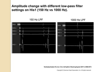Amplitude change with different low-pass filter
settings on His1 (150 Hz vs 1000 Hz).
Venkatachalam K et al. Circ Arrhythm Electrophysiol 2011;4:965-973
Copyright © American Heart Association, Inc. All rights reserved.
 
