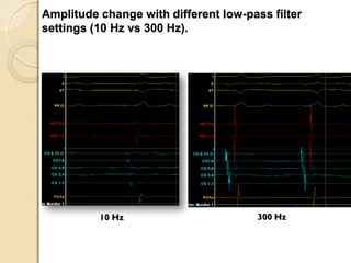 Amplitude change with different low-pass filter
settings (10 Hz vs 300 Hz).
10 Hz 300 Hz
 