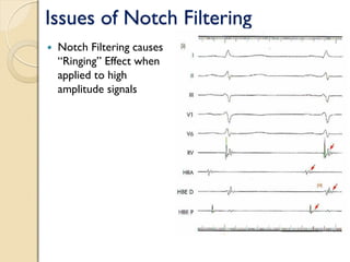 Issues of Notch Filtering
 Notch Filtering causes
“Ringing” Effect when
applied to high
amplitude signals
 