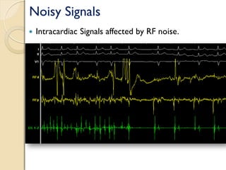 Noisy Signals
 Intracardiac Signals affected by RF noise.
 