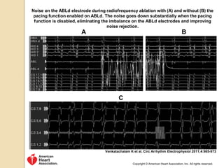 Noise on the ABLd electrode during radiofrequency ablation with (A) and without (B) the
pacing function enabled on ABLd. The noise goes down substantially when the pacing
function is disabled, eliminating the imbalance on the ABLd electrodes and improving
noise rejection.
Venkatachalam K et al. Circ Arrhythm Electrophysiol 2011;4:965-973
Copyright © American Heart Association, Inc. All rights reserved.
 
