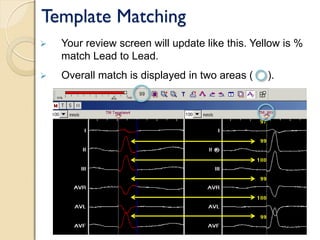 Template Matching
 Your review screen will update like this. Yellow is %
match Lead to Lead.
 Overall match is displayed in two areas ( ).
 