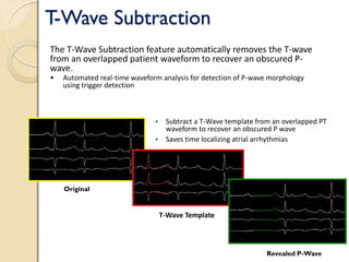 T-Wave Subtraction
 Subtract a T-Wave template from an overlapped PT
waveform to recover an obscured P wave
 Saves time localizing atrial arrhythmias
Original
Revealed P-Wave
T-Wave Template
• Automated real-time waveform analysis for detection of P-wave morphology
using trigger detection
The T-Wave Subtraction feature automatically removes the T-wave
from an overlapped patient waveform to recover an obscured P-
wave.
 